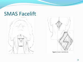SMAS Facelift
38
 