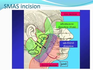 SMAS incision
39
 