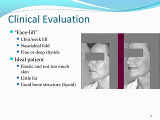 Clinical Evaluation
“Face-lift”
Chin/neck lift
Nasolabial fold
Fine or deep rhytids
Ideal patient
Elastic and not too much
skin
Little fat
Good bone structure (hyoid)
4
 