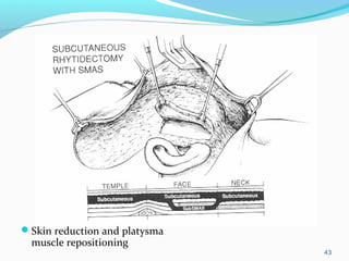 Skin reduction and platysma
muscle repositioning
43
 