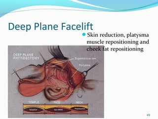 Deep Plane Facelift
Skin reduction, platysma
muscle repositioning and
cheek fat repositioning
49
 