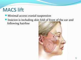 MACS lift
Minimal access cranial suspension
Insicion is including skin fold of front of the ear and
following hairline
52
 