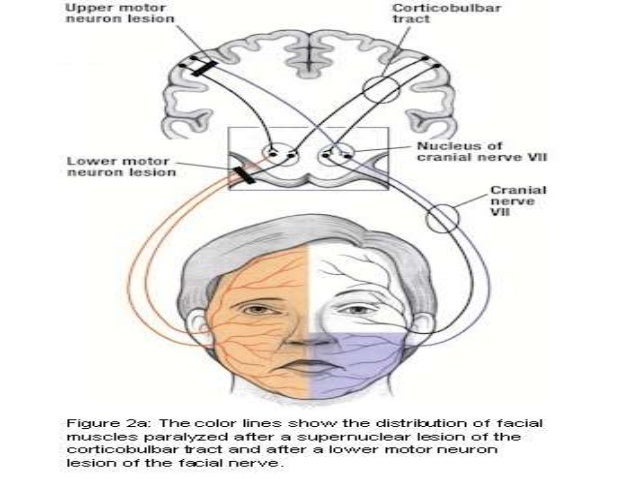 Facial nerve traumatic injury and repair