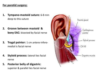 For parotid surgery:
1. Tympano-mastoid suture: 6-8 mm
deep to this suture
2. Groove between mastoid &
bony EAC: bisected by facial nerve
3. Tragal pointer: 1 cm antero-infero-
medial is facial nerve
4. Styloid process: lateral lies facial
nerve
5. Posterior belly of digastric:
superior & parallel lies facial nerve
 