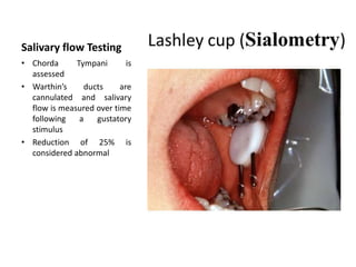 Salivary flow Testing
• Chorda Tympani is
assessed
• Warthin’s ducts are
cannulated and salivary
flow is measured over time
following a gustatory
stimulus
• Reduction of 25% is
considered abnormal
 