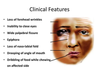 Clinical Features
• Loss of forehead wrinkles
• Inability to close eyes
• Wide palpebral fissure
• Epiphora
• Loss of naso-labial fold
• Drooping of angle of mouth
• Dribbling of food while chewing
on affected side
 