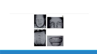 Facial nerve REVISION NOTES