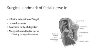 Surgical landmark of facial nerve in
• Inferior extension of Tragal
• styloid process
• Posterior belly of digastric
• Marginal mandibular nerve
• Tracing retrograde manner
 