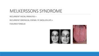 MELKERSSONS SYNDROME
RECURRENT FACIAL PARALYSIS +
RECURRENT OROFACIAL EDEMA  SWOLLEN LIPS +
FISSURED TONGUE
 