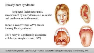 Ramsay hunt syndrome:
Peripheral facial nerve palsy
accompanied by an erythematous vesicular
rash on the ear or in the mouth.
Varicella zoster virus (VZV) causes
Ramsay Hunt syndrome.
Bell’s palsy is significantly associated
with herpes simplex virus (HSV)
Ramsay Hunt syndrome C J Sweeney, D H Gilden; Jounal of Neurology, Neurosurgery and Psychiatry 2001
 