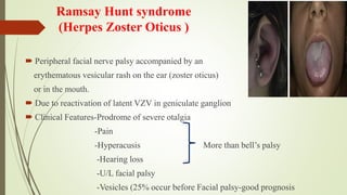 Ramsay Hunt syndrome
(Herpes Zoster Oticus )
 Peripheral facial nerve palsy accompanied by an
erythematous vesicular rash on the ear (zoster oticus)
or in the mouth.
 Due to reactivation of latent VZV in geniculate ganglion
 Clinical Features-Prodrome of severe otalgia
-Pain
-Hyperacusis More than bell’s palsy
-Hearing loss
-U/L facial palsy
-Vesicles (25% occur before Facial palsy-good prognosis
 