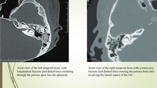Axial view of the left temporal bone, with
longitudinal fracture (red dotted line) extending
through the petrous apex into the sphenoid
Axial view of the right temporal bone with a transverse
fracture (red dashed line) crossing the petrous bone and
involving the lateral aspect of the IAC.
 
