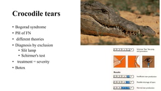 Crocodile tears
• Bogorad syndrome
• PH of FN
• different theories
• Diagnosis by exclusion
• Slit lamp
• Schirmer's test
• treatment = severity
• Botox
 