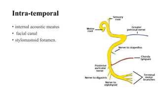 Intra-temporal
• internal acoustic meatus
• facial canal
• stylomastoid foramen.
 