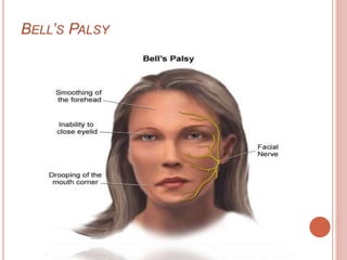BELL’S PALSY
 