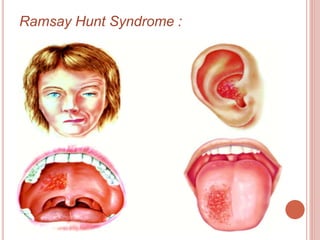 Ramsay Hunt Syndrome :
 