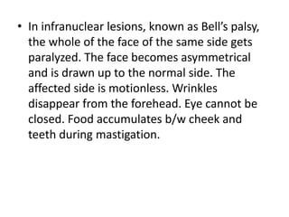 • In infranuclear lesions, known as Bell’s palsy,
the whole of the face of the same side gets
paralyzed. The face becomes asymmetrical
and is drawn up to the normal side. The
affected side is motionless. Wrinkles
disappear from the forehead. Eye cannot be
closed. Food accumulates b/w cheek and
teeth during mastigation.
 