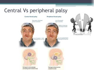 Central Vs peripheral palsy
 