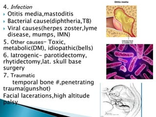 4. Infection
 Otitis media,mastoditis
 Bacterial cause(diphtheria,TB)
 Viral causes(herpes zoster,lyme
disease, mumps, IMN)
5. Other causes- Toxic,
metabolic(DM), idiopathic(bells)
6. Iatrogenic- parotidectomy,
rhytidectomy,lat. skull base
surgery
7. Traumatic
temporal bone #,penetrating
trauma(gunshot)
Facial lacerations,high altitude
palsy
 