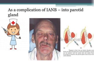 As a complication of IANB – into parotid
gland
 