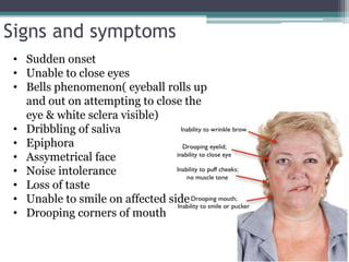 Signs and symptoms
• Sudden onset
• Unable to close eyes
• Bells phenomenon( eyeball rolls up
and out on attempting to close the
eye & white sclera visible)
• Dribbling of saliva
• Epiphora
• Assymetrical face
• Noise intolerance
• Loss of taste
• Unable to smile on affected side
• Drooping corners of mouth
 