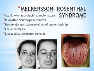 *
*Also known as orofacial granulomatosis
*Idiopathic Neurological disorder
*Non tender persistent swelling of one or both lip
*Facial paralysis
*Lingua plicata(fissured tongue)
 