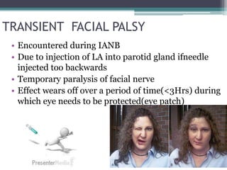 TRANSIENT FACIAL PALSY
• Encountered during IANB
• Due to injection of LA into parotid gland ifneedle
injected too backwards
• Temporary paralysis of facial nerve
• Effect wears off over a period of time(<3Hrs) during
which eye needs to be protected(eye patch)
 