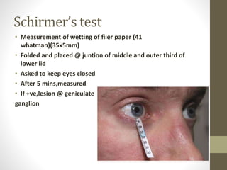 Schirmer’s test
• Measurement of wetting of filer paper (41
whatman)(35x5mm)
• Folded and placed @ juntion of middle and outer third of
lower lid
• Asked to keep eyes closed
• After 5 mins,measured
• If +ve,lesion @ geniculate
ganglion
 