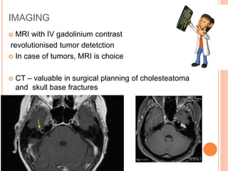 IMAGING
 MRI with IV gadolinium contrast
revolutionised tumor detetction
 In case of tumors, MRI is choice
 CT – valuable in surgical planning of cholesteatoma
and skull base fractures
 Exclusion of other pathologies
 
