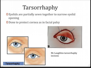Tarsorrhaphy
0 Eyelids are partially sewn together to narrow eyelid
opening
0 Done to protect cornea as in facial palsy
Mc Laughlins tarsorrhaphy
incisons
 