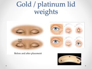 Gold / platinum lid
weights
Before and after placement
 
