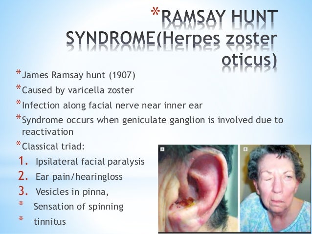 Facial nerve and its disorders