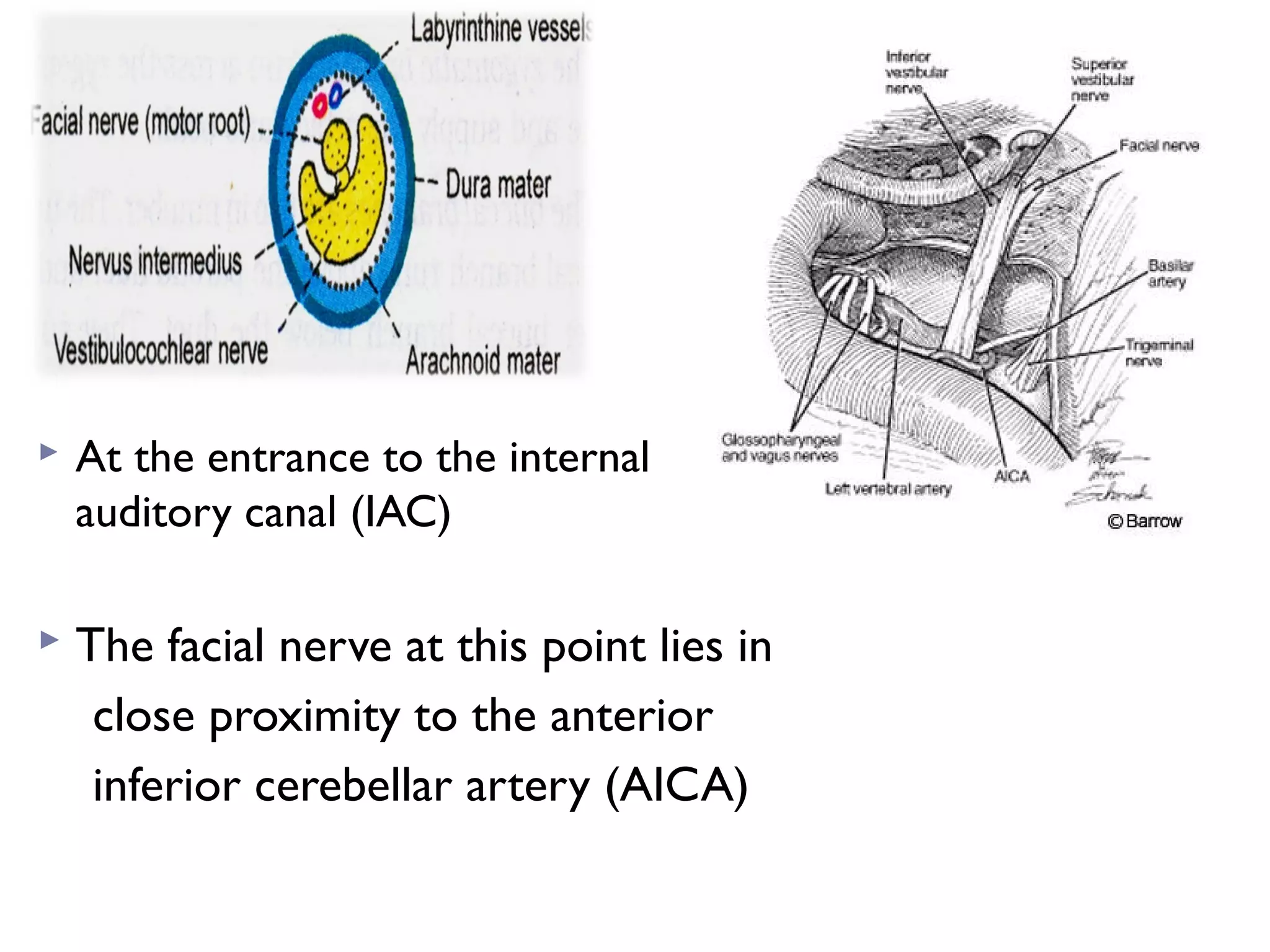  At the entrance to the internal
auditory canal (IAC)
 The facial nerve at this point lies in
close proximity to the anterior
inferior cerebellar artery (AICA)
 