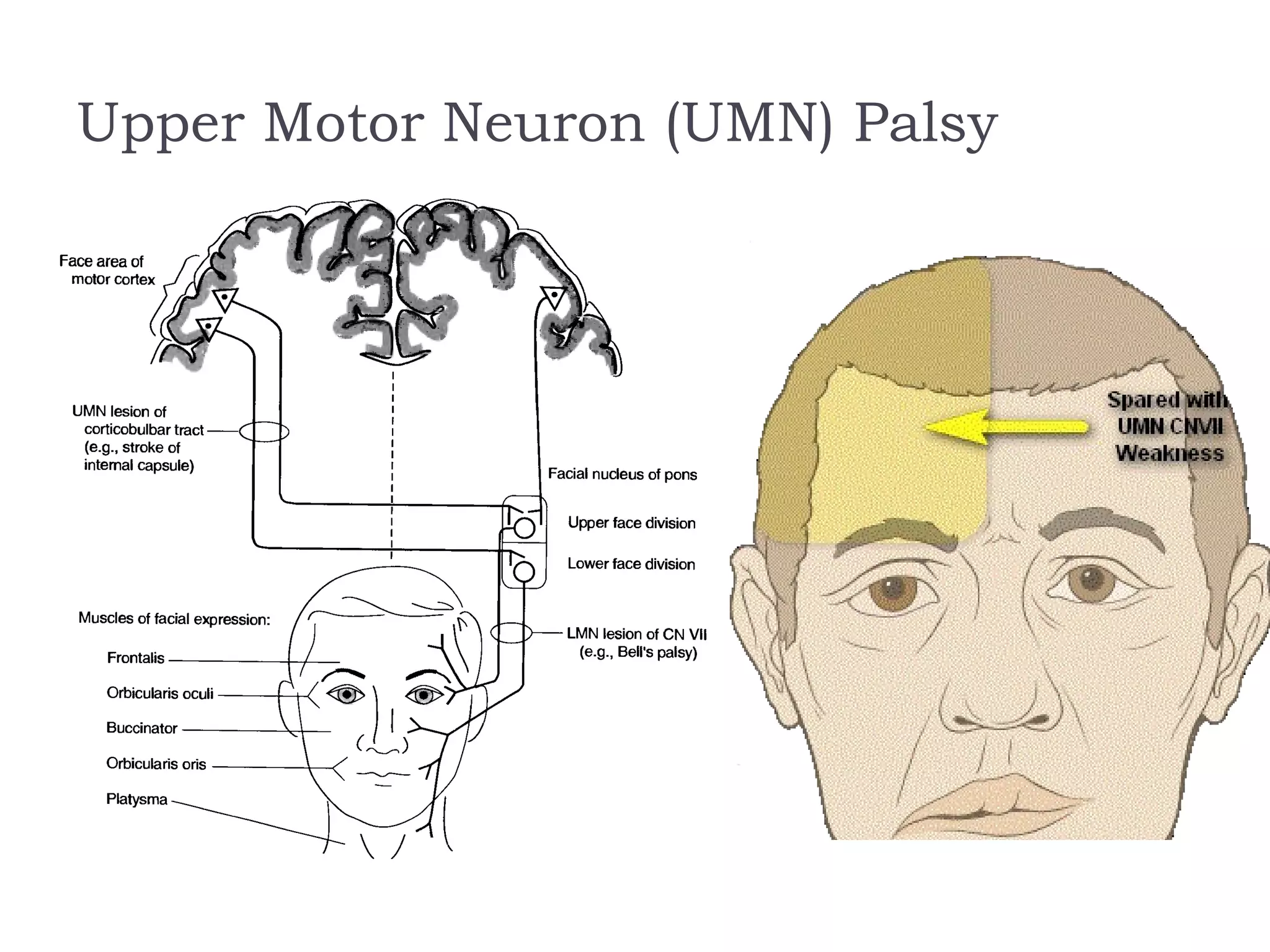 Upper Motor Neuron (UMN) Palsy
 