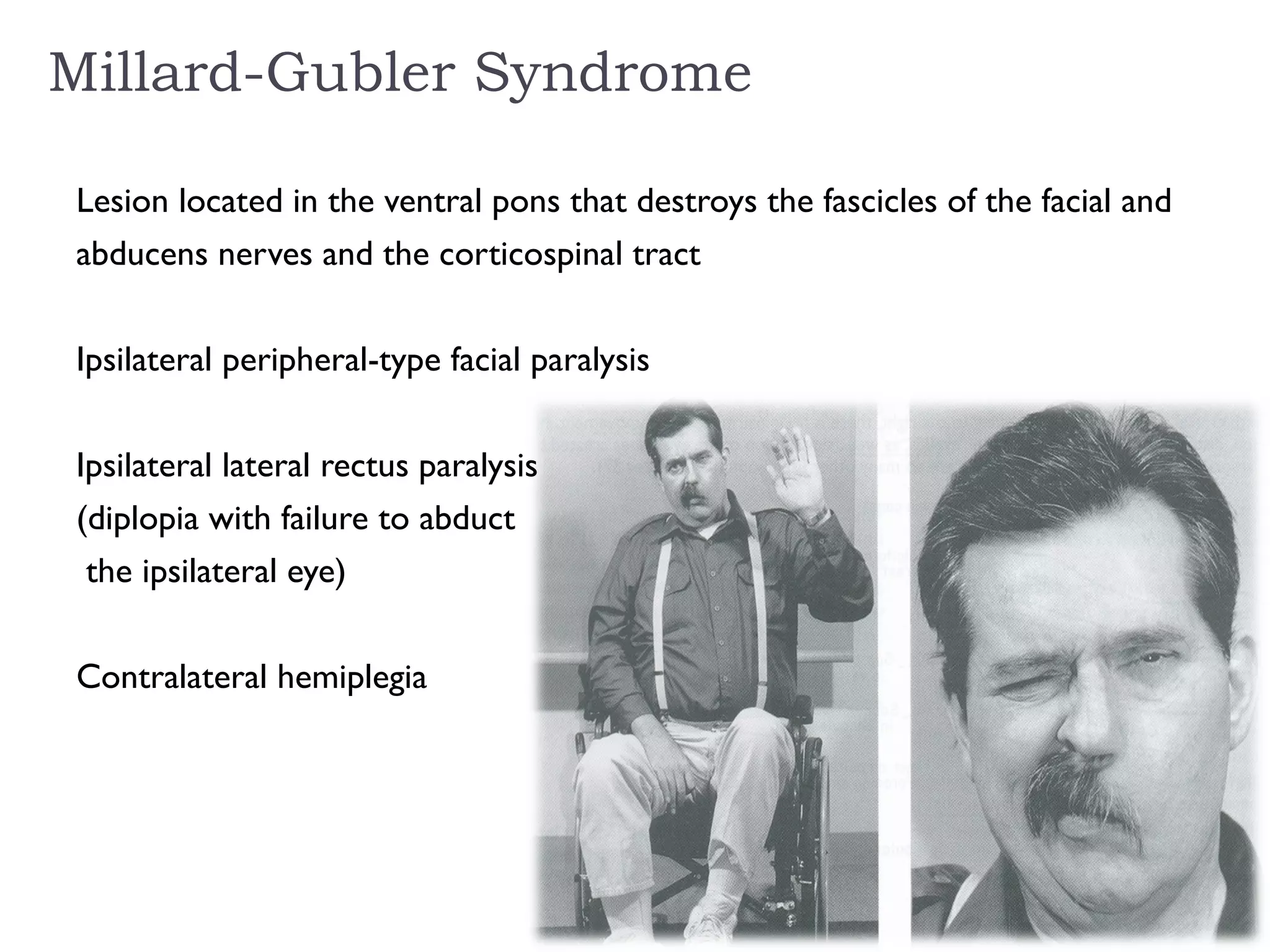 Millard-Gubler Syndrome
Lesion located in the ventral pons that destroys the fascicles of the facial and
abducens nerves and the corticospinal tract
Ipsilateral peripheral-type facial paralysis
Ipsilateral lateral rectus paralysis
(diplopia with failure to abduct
the ipsilateral eye)
Contralateral hemiplegia
 
