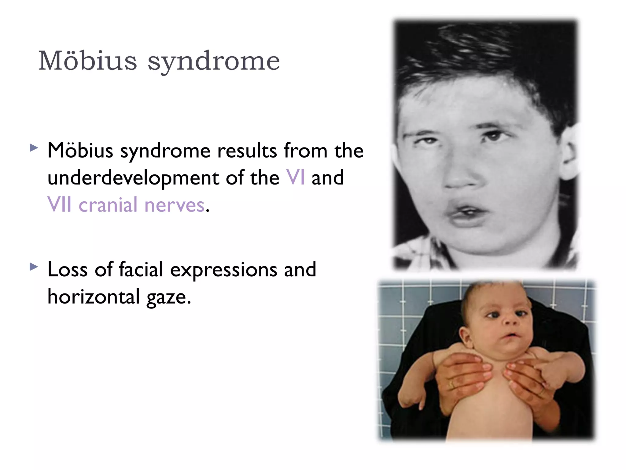 Möbius syndrome
 Möbius syndrome results from the
underdevelopment of the VI and 
VII cranial nerves.
 Loss of facial expressions and
horizontal gaze.
 