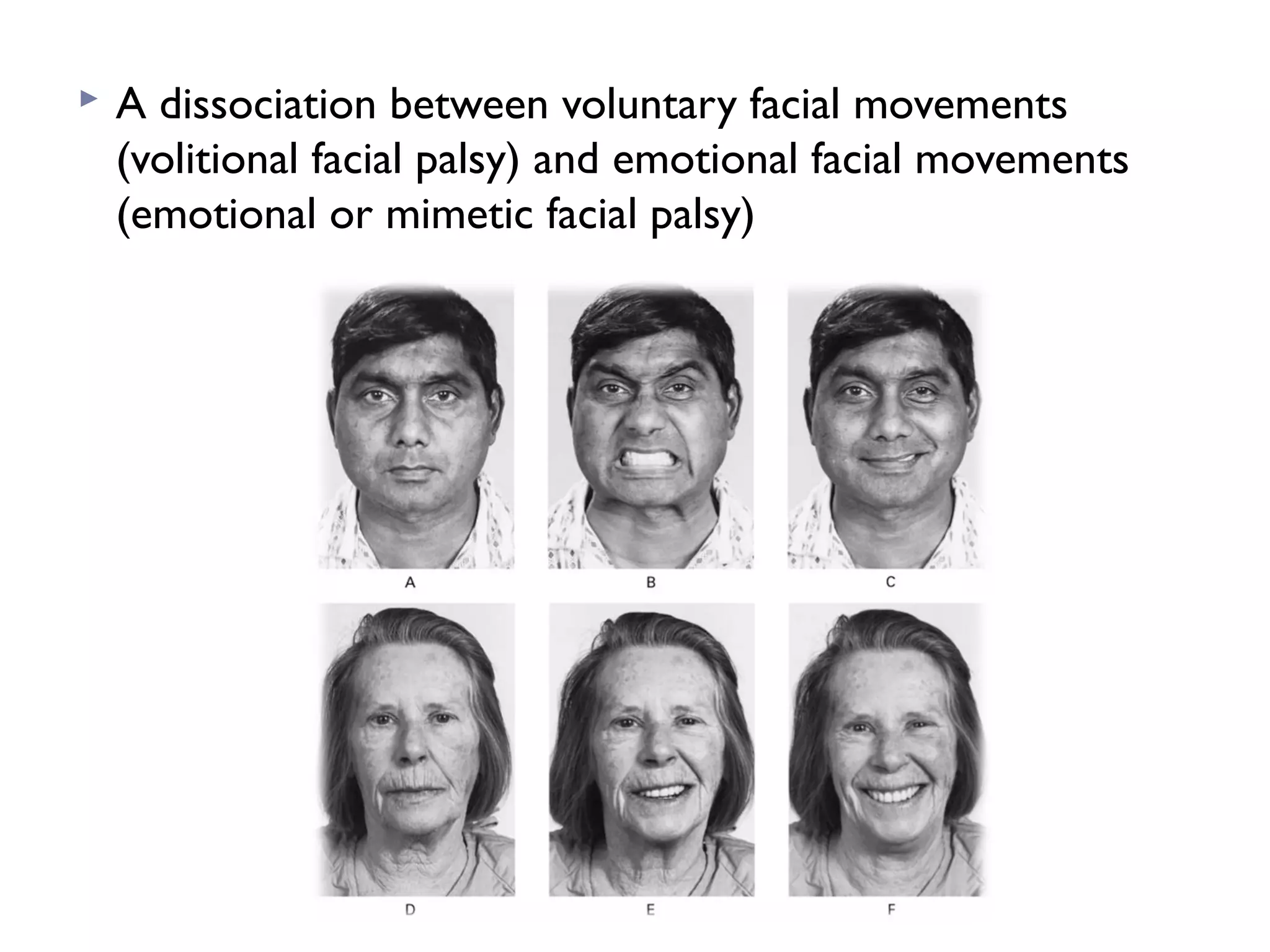  A dissociation between voluntary facial movements
(volitional facial palsy) and emotional facial movements
(emotional or mimetic facial palsy)
 
