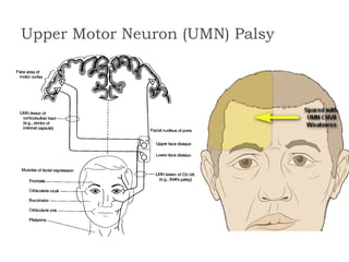 Upper Motor Neuron (UMN) Palsy
 