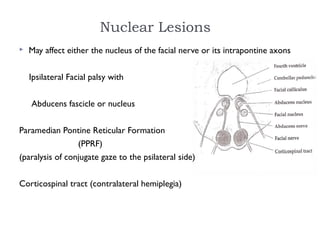 Nuclear Lesions
 May affect either the nucleus of the facial nerve or its intrapontine axons
Ipsilateral Facial palsy with
Abducens fascicle or nucleus
Paramedian Pontine Reticular Formation
(PPRF)
(paralysis of conjugate gaze to the psilateral side)
Corticospinal tract (contralateral hemiplegia)
 