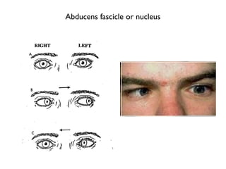 Abducens fascicle or nucleus
 