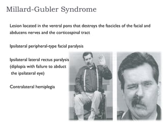 Millard-Gubler Syndrome
Lesion located in the ventral pons that destroys the fascicles of the facial and
abducens nerves and the corticospinal tract
Ipsilateral peripheral-type facial paralysis
Ipsilateral lateral rectus paralysis
(diplopia with failure to abduct
the ipsilateral eye)
Contralateral hemiplegia
 
