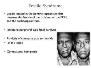 Foville Syndrome
 Lesion located in the pontine tegmentum that
destroys the fascicle of the facial nerve, the PPRF,
and the corticospinal tract.
 Ipsilateral peripheral-type facial paralysis
 Paralysis of conjugate gaze to the side
 of the lesion
 Contralateral hemiplegia
 
