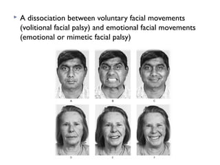  A dissociation between voluntary facial movements
(volitional facial palsy) and emotional facial movements
(emotional or mimetic facial palsy)
 