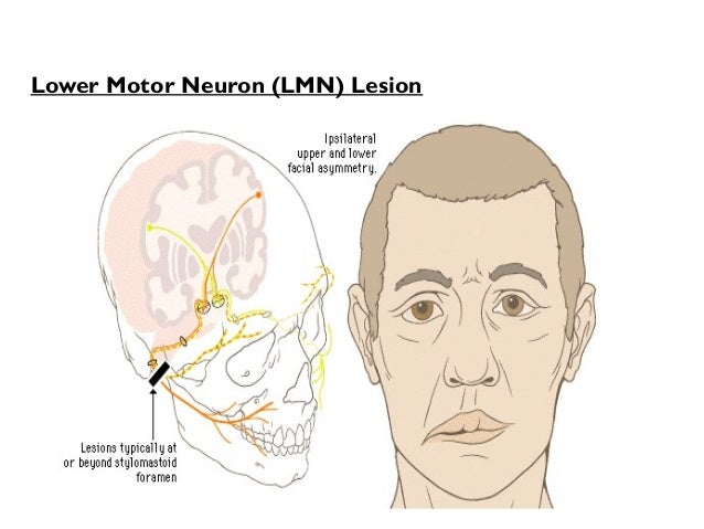 upper-motor-neuron-corticospinal-facial-changes-pussy-gifs-free
