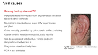 Viral causes
Ramsay hunt syndrome-VZV
Peripheral facial nerve palsy with erythematous vesicular
rash on ear or in mouth
Mechanism- reactivation of latent VZV in geniculate
ganglion
Onset - usually preceded by pain- persist and excrutiating
Ocular- uveitis, keratoconjunctivitis, optic neuritis
Can be associated with tinnitus, vertigo and snhl
(labyrinthine involvement )
Diagnosis- raised antibody titres
PCR in ear exudates
 