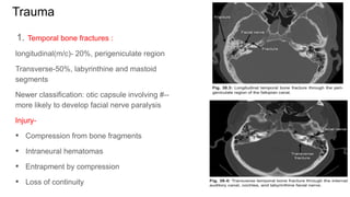 Trauma
1. Temporal bone fractures :
longitudinal(m/c)- 20%, perigeniculate region
Transverse-50%, labyrinthine and mastoid
segments
Newer classification: otic capsule involving #--
more likely to develop facial nerve paralysis
Injury-
• Compression from bone fragments
• Intraneural hematomas
• Entrapment by compression
• Loss of continuity
 