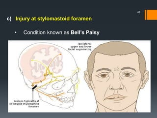 c) Injury at stylomastoid foramen
• Condition known as Bell’s Palsy
46
 