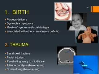 1. BIRTH
 Forceps delivery
 Dystrophia myotonica
 Moebius' syndrome (facial diplegia
 associated with other cranial nerve deficits)
2. TRAUMA
 Basal skull fracture
 Facial injuries
 Penetrating injury to middle ear
 Altitude paralysis (barotrauma)
 Scuba diving (barotrauma)
48
 