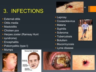49
3. INFECTIONS
 External otitis
 Otitis media
 Mastoiditis
 Chicken pox
 Herpes zoster (Ramsay Hunt
 syndrome)
 Encephalitis
 Poliomyelitis (type I)
 Mumps
 Leprosy
 Coxsackievirus
 Malaria
 Syphilis
 Scleroma
 Tuberculosis
 Botulism
 Mucormycosis
 Lyme disease
 