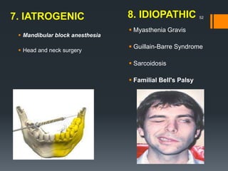 7. IATROGENIC 8. IDIOPATHIC 52
 Mandibular block anesthesia
 Head and neck surgery
 Myasthenia Gravis
 Guillain-Barre Syndrome
 Sarcoidosis
 Familial Bell's Palsy
 